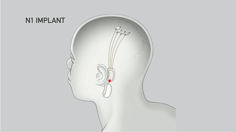 BCI Neuralink Implant